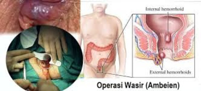 Jual Obat Wasir Ambeien De Nature Pengiriman ke Tanah Bumbu